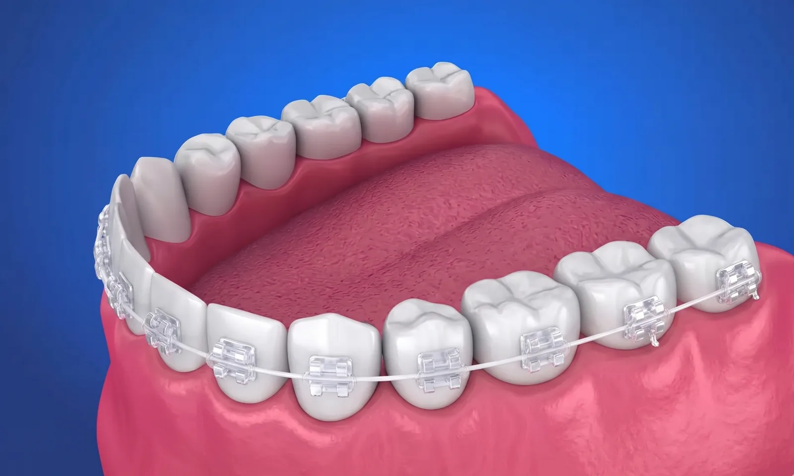 Braces & Invisalign