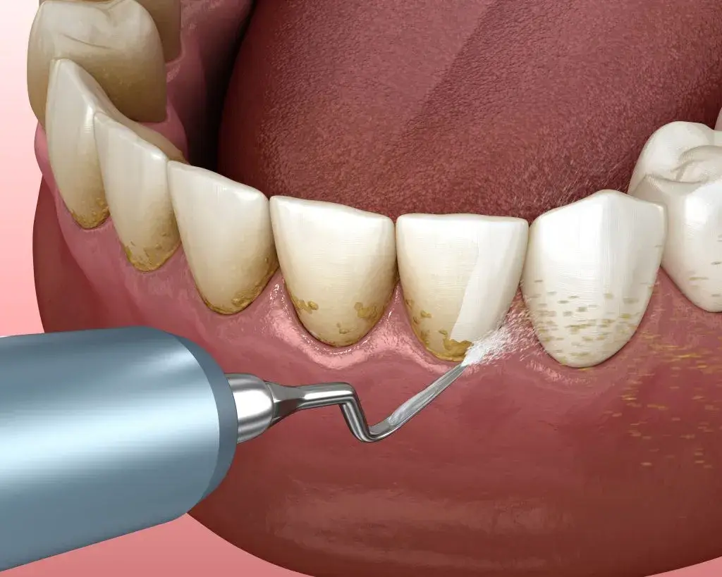 Deep cleaning (scaling)