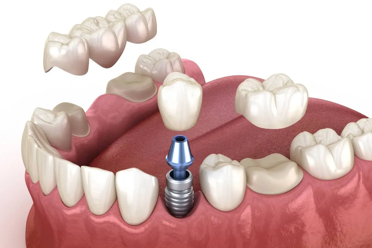 Dental implants
