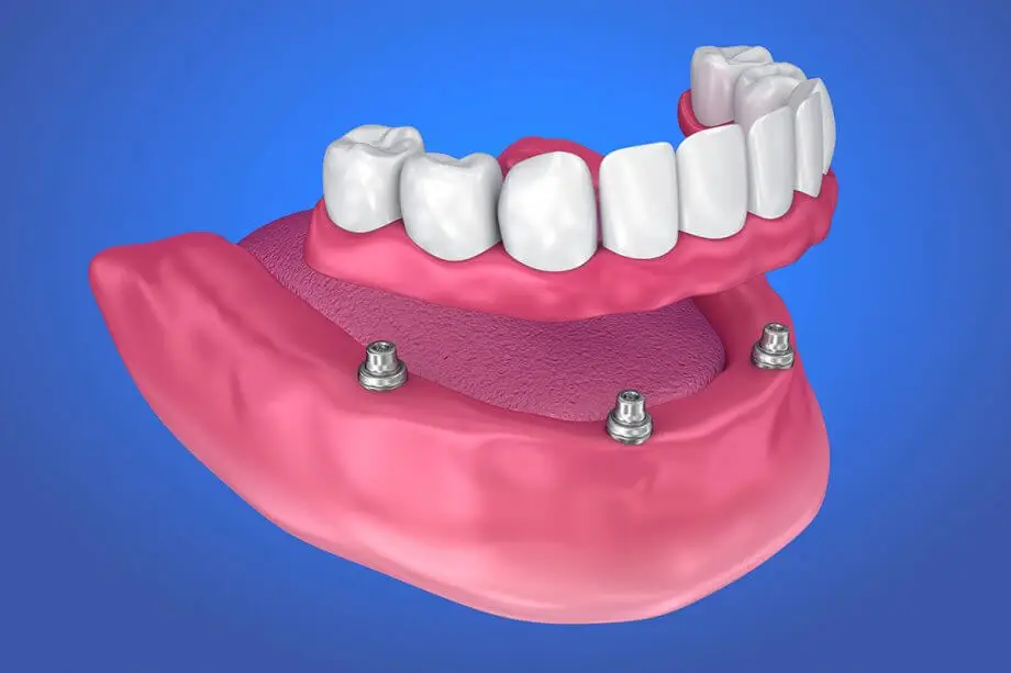 Dentures & partials