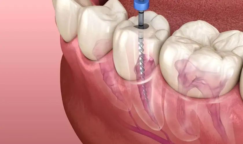 Root canal therapy