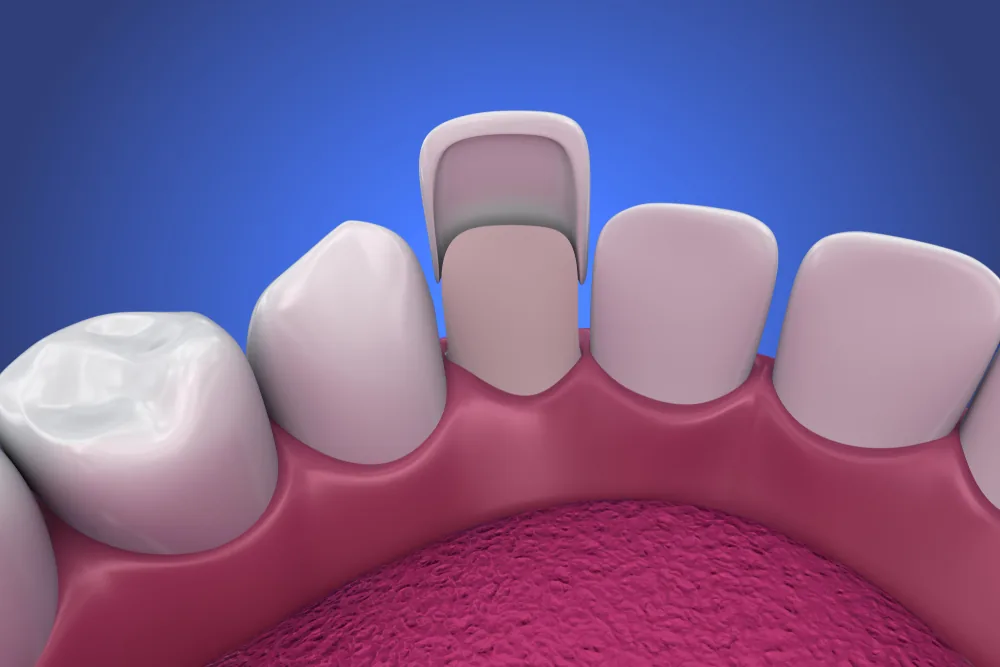 Porcelain veneers